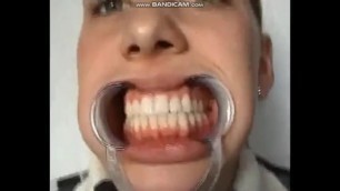 Mouth Spreader used at Dentist