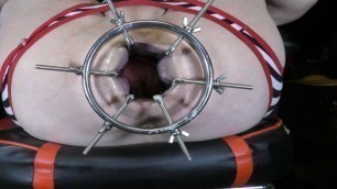 Demonstration and installation of the anal retractor